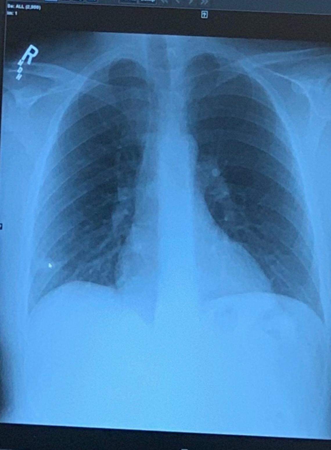 An X-ray image of Jordan Josey’s lungs shows his left lung, on right, partially collapsed. Josey, 28, first felt symptoms of the coronavirus on the morning of March 17. He sought help at a string of medical facilities in Macon.