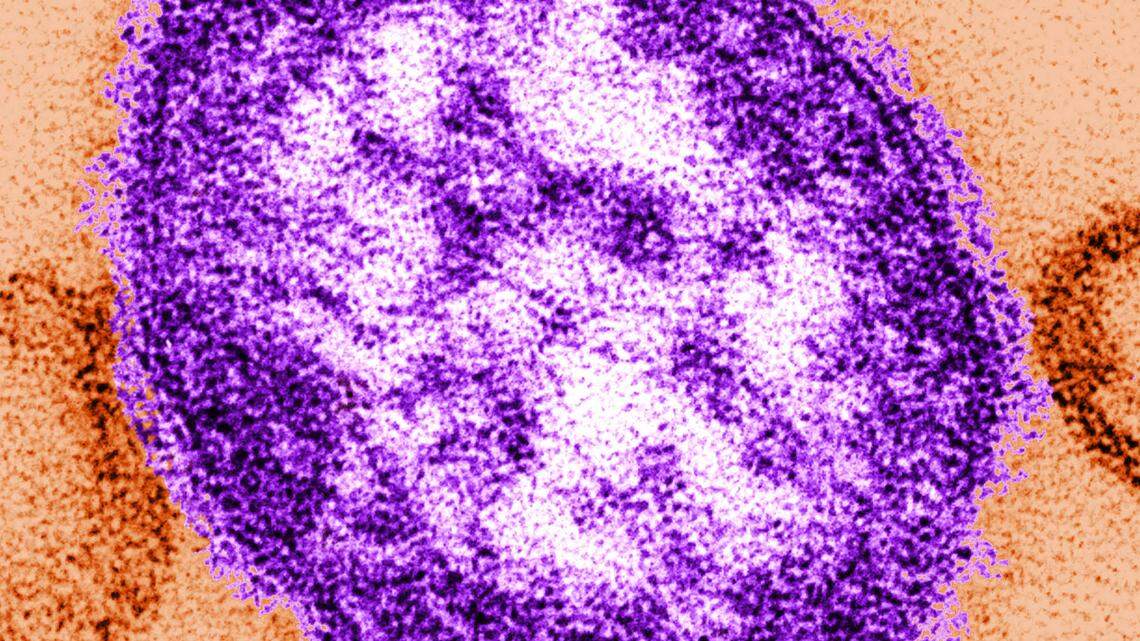 The measles virus is spread through the air when an infected person coughs or sneezes. (AP Photo/Centers for Disease Control and Prevention, Cynthia Goldsmith)