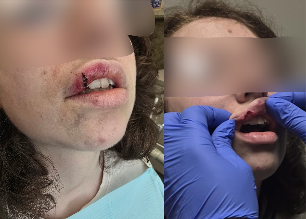 The daughter of Jessica Strohmetz sustained multiple injuries including deep lip cuts, several loose teeth and facial bruising after an altercation at Rutland Middle School in Macon. (Courtesy/Strohmetz Family)