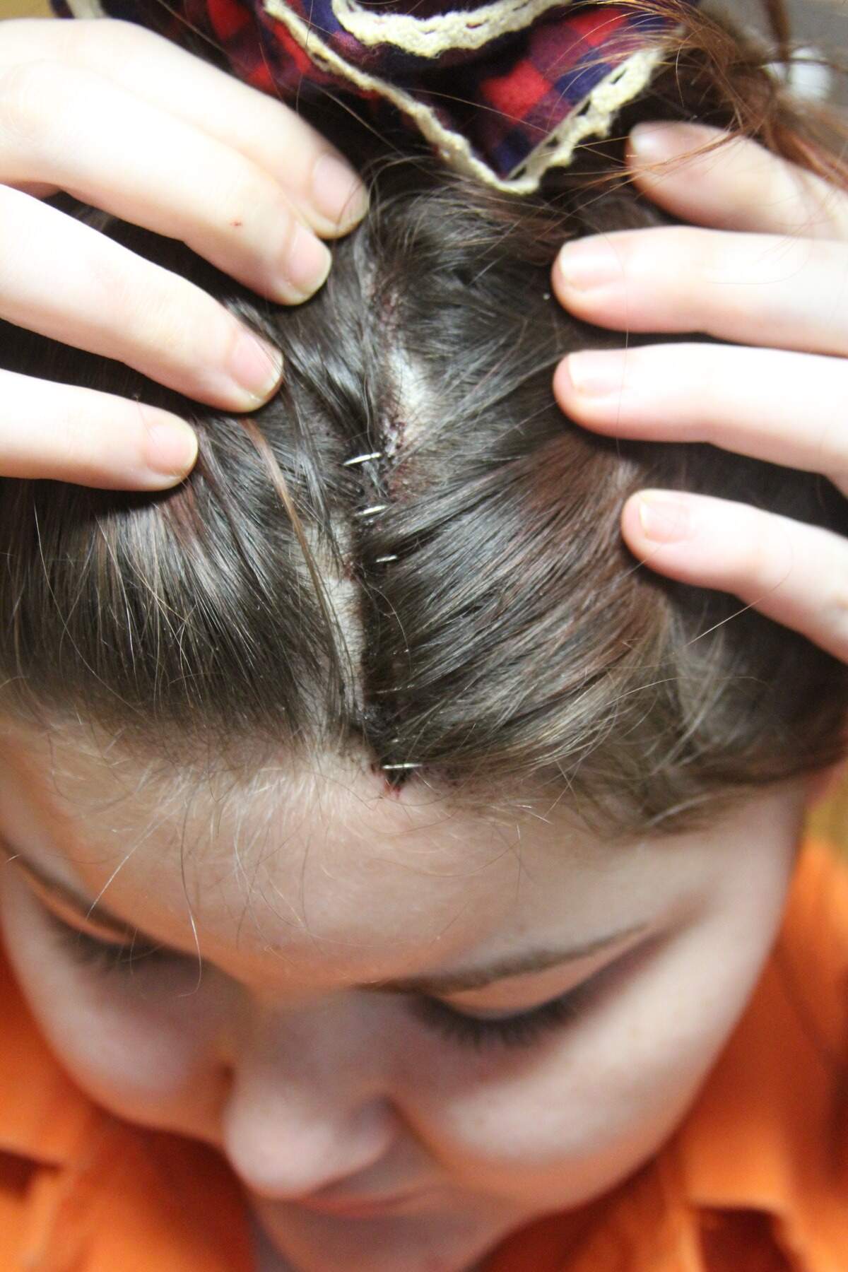 India Martin’s head wound.